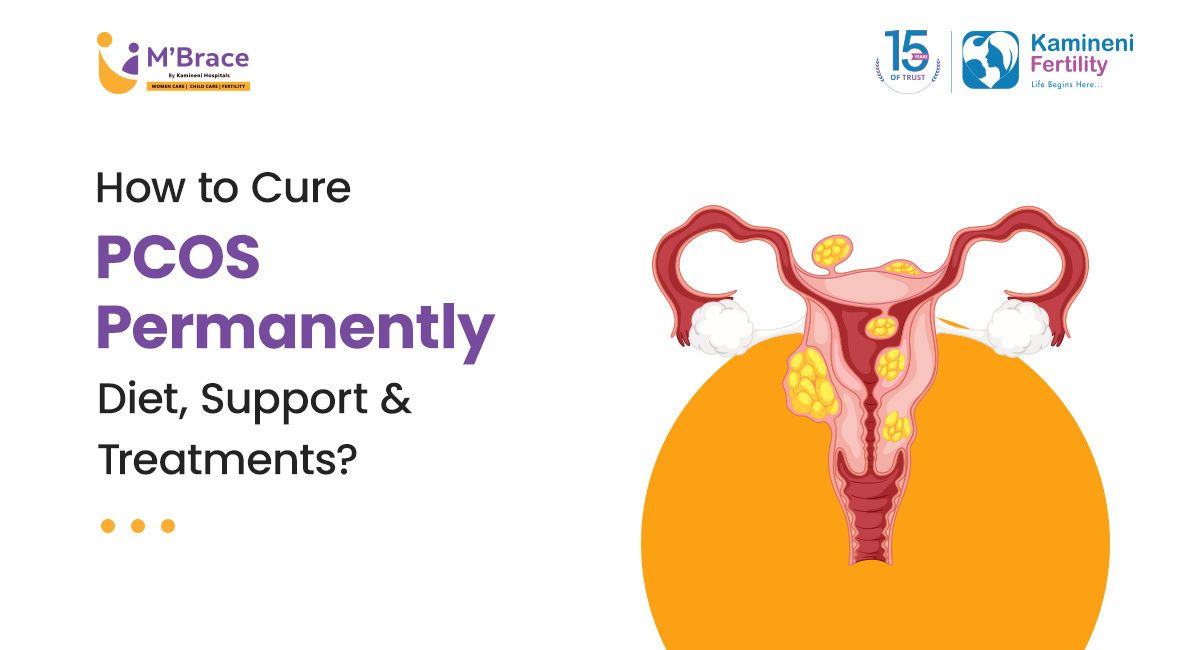 How to Cure PCOS Permanently